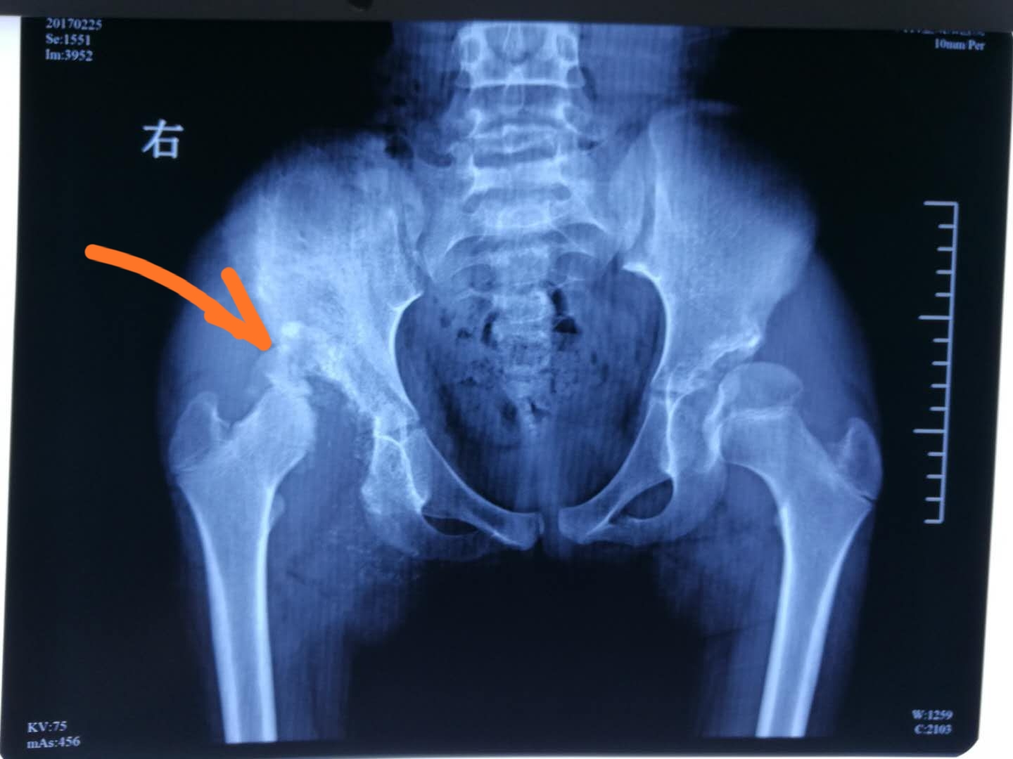 花季少女失去知觉,15岁花季少女得了一种罕见的病