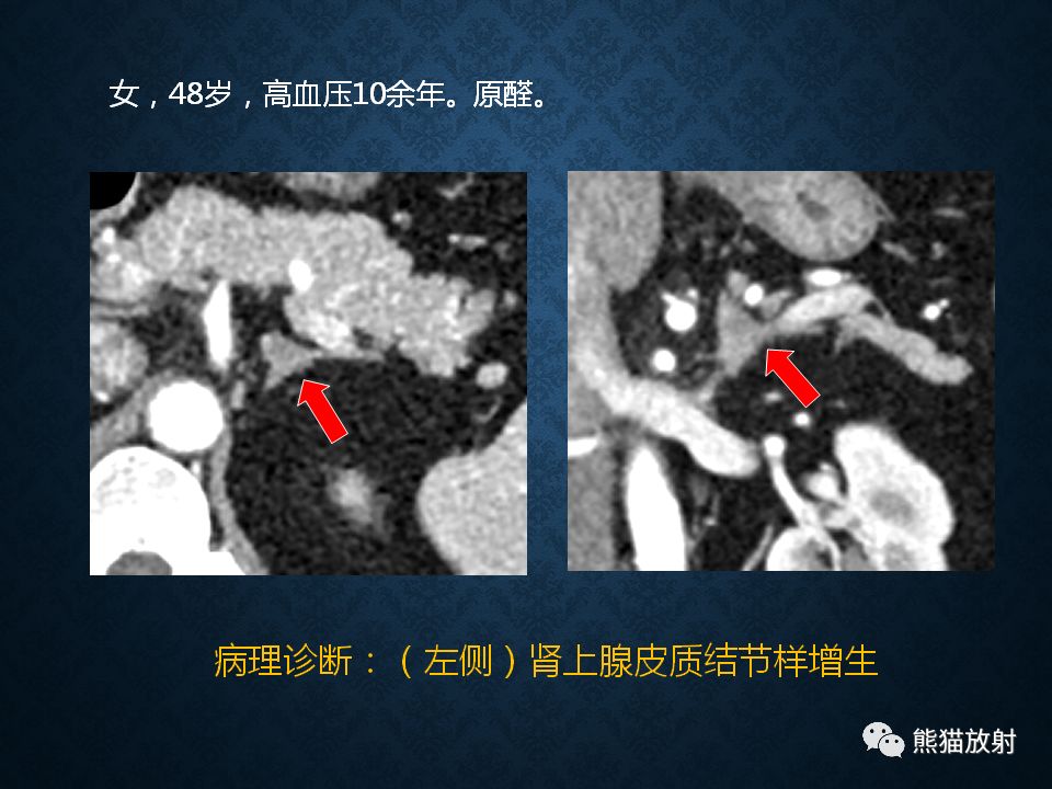 纵隔和肾上腺恶性肿瘤,纵隔性肿瘤位置图