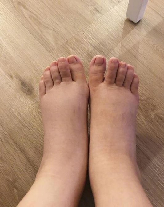 35周脚肿得像个猪蹄一样怎么缓解,孕晚期脚肿得像猪蹄怎么缓解