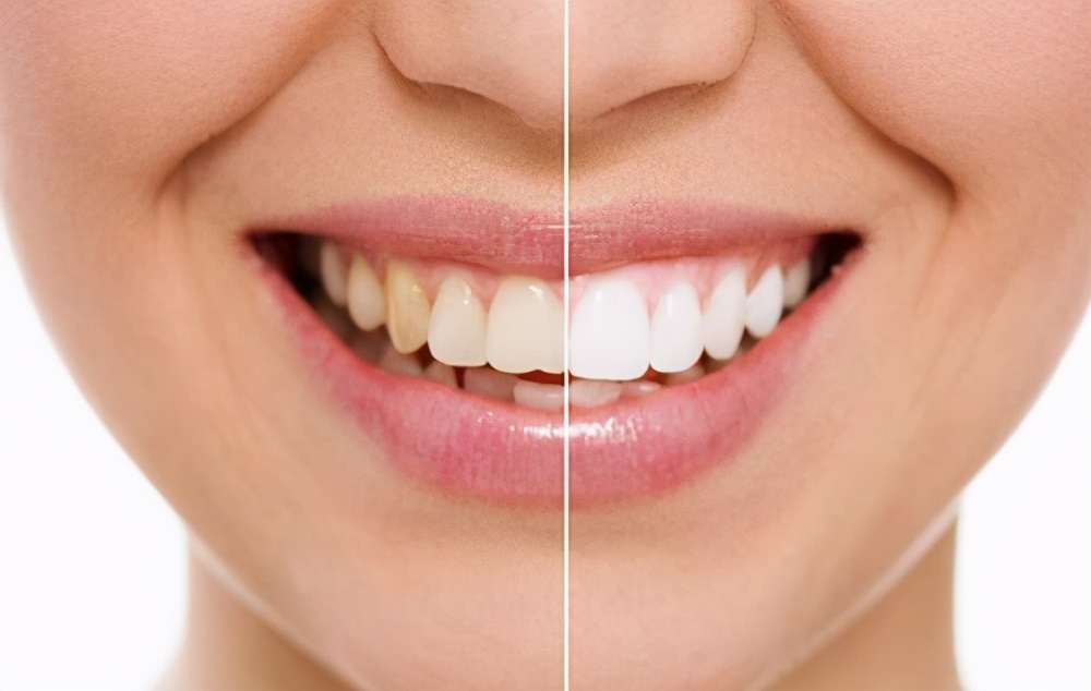 皓齿美白费用要多少,皓齿美白需要做几次