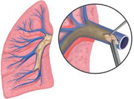 血栓高血压的症状和治疗,慢性肺血栓栓塞性肺动脉高压预后