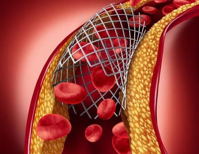 心脏植入支架后有多长时间能拔牙,心脏植入支架对心脏有多大影响