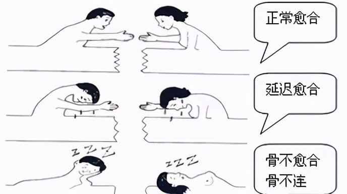 骨折术后为什么总是不舒服,骨折术后为什么有的人不愈合