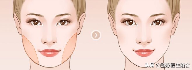 下颌角整形│对不起，你的脸让我的心好“方”