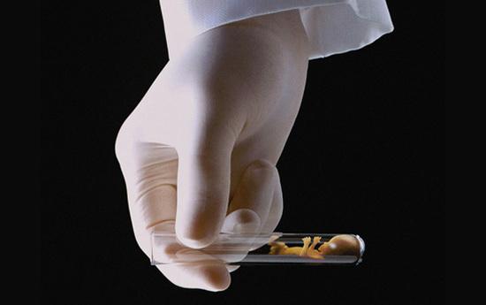 输卵管造影和输卵管通液区别,输卵管造影就是输卵管通液吗