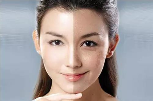 激光皮秒祛斑为什么会反黑,皮秒激光祛斑后怎么预防反黑