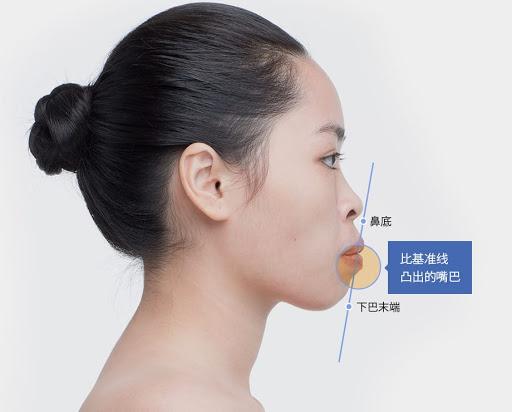 突嘴正颌手术有哪些风险,正颌手术凸嘴3d动画演示