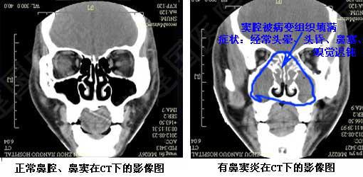 儿童鼻窦炎用什么药治疗最见效,小孩有鼻窦炎用什么药比较好