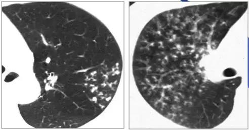肺部ct十大征象,肺部ct正常图和异常图的区别