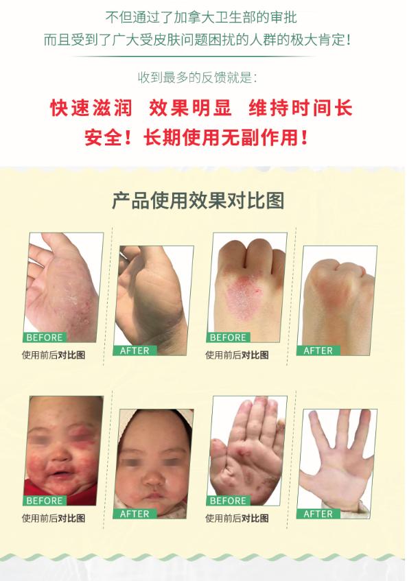 拯救湿疹,拿什么拯救你保健品
