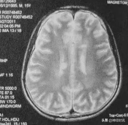 中医治疗多发性硬化的成功病例,今日病例