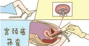 请收藏，迄今最全面的宫颈癌疫苗问答，都在这了