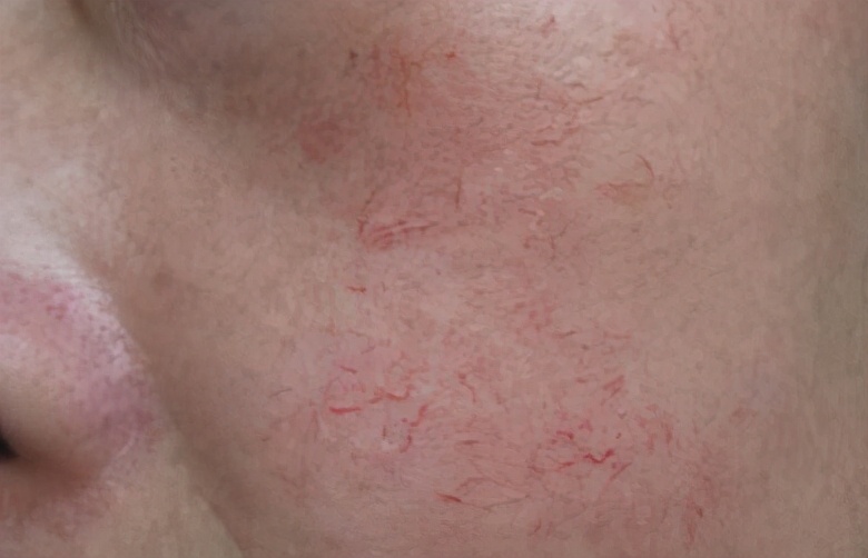 脸部红血丝多怎么消除,脸部红血丝怎么消除小妙招