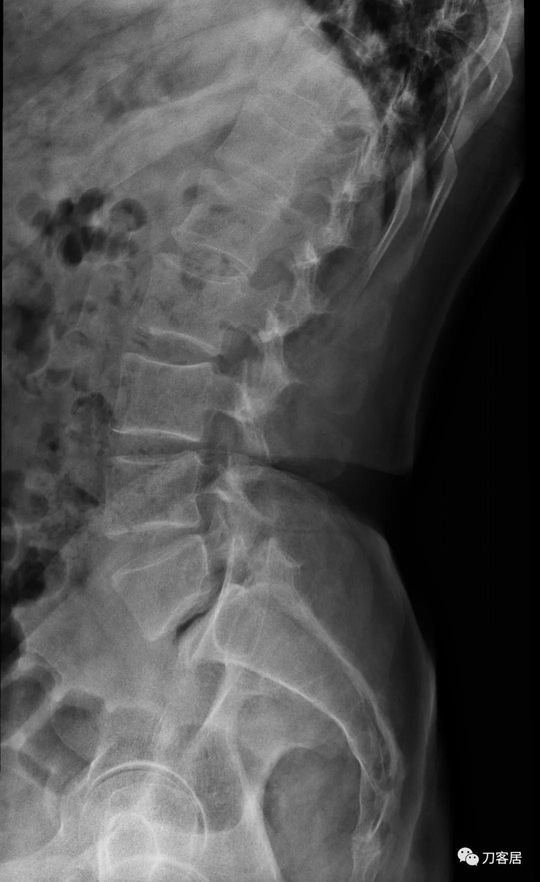 小针刀扎到坐骨神经会瘫痪吗,小针刀会切断坐骨神经吗