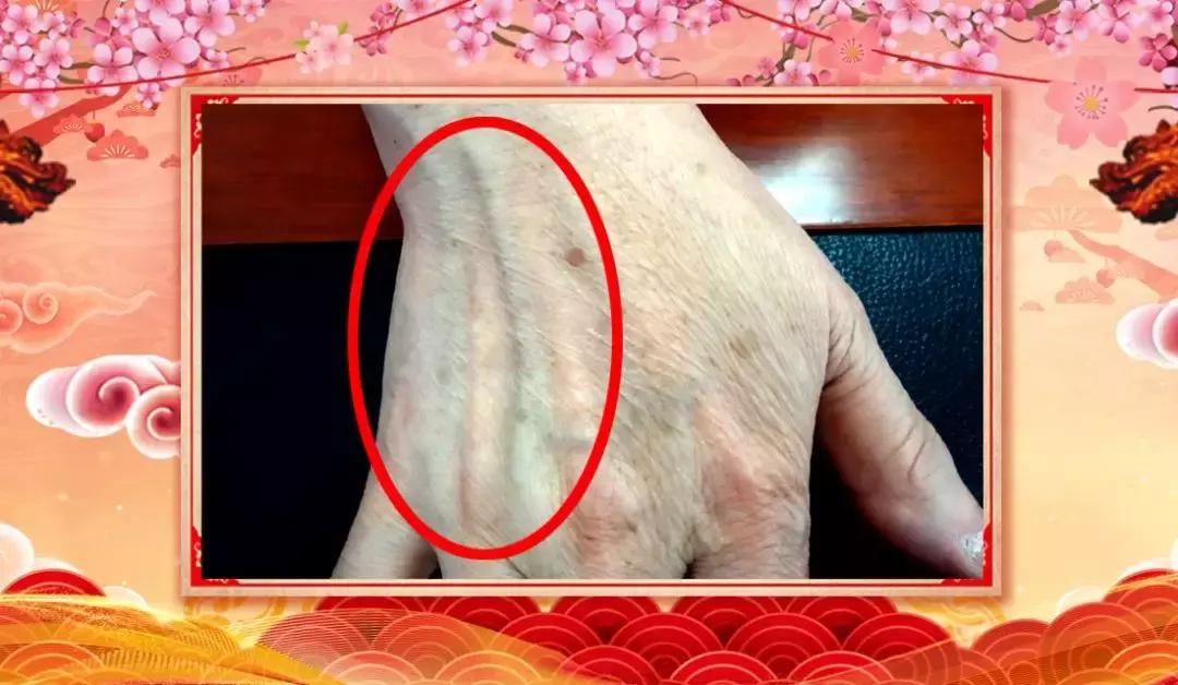 手心青筋突然发紫怎么回事,大鱼际青筋明显是心脏不好吗