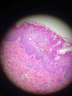 女儿得了银屑病怎么办,宝宝湿疹和银屑病区别