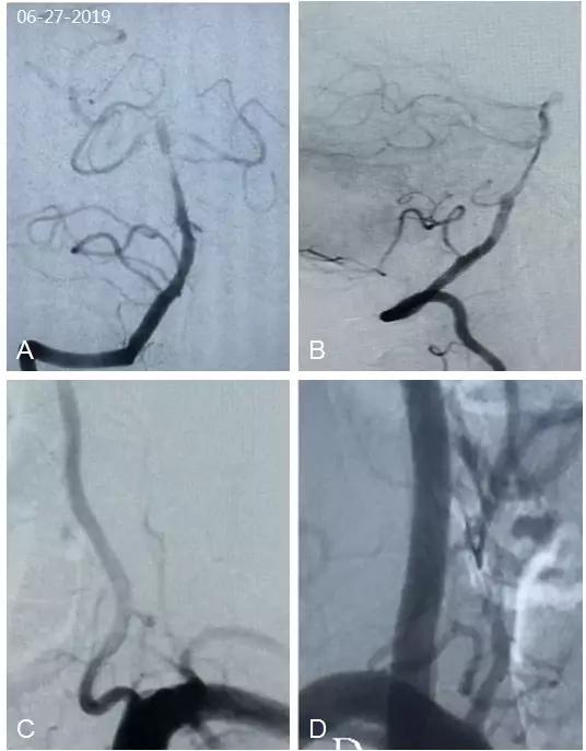 基底动脉狭窄介入指南,基底动脉重度狭窄用药用量