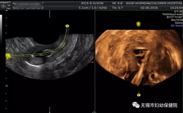 「热点关注」四维超声输卵管造影术帮您“指明”孕育之路