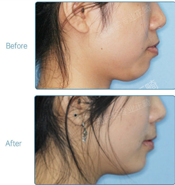 杭州牙齿矫正的全过程,杭州牙齿矫正哪个医生最好