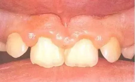 宝宝长牙牙龈痛怎么办吃什么药好,宝宝长牙牙龈肿痛怎样治疗