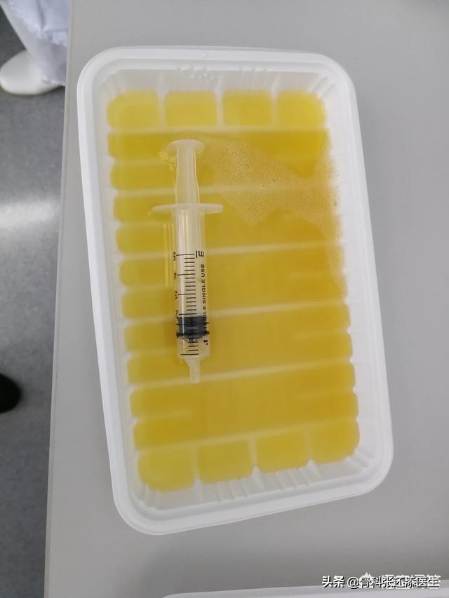 花椒和白醋对关节炎积液有效果吗,盐加花椒热敷膝关节积液管用吗