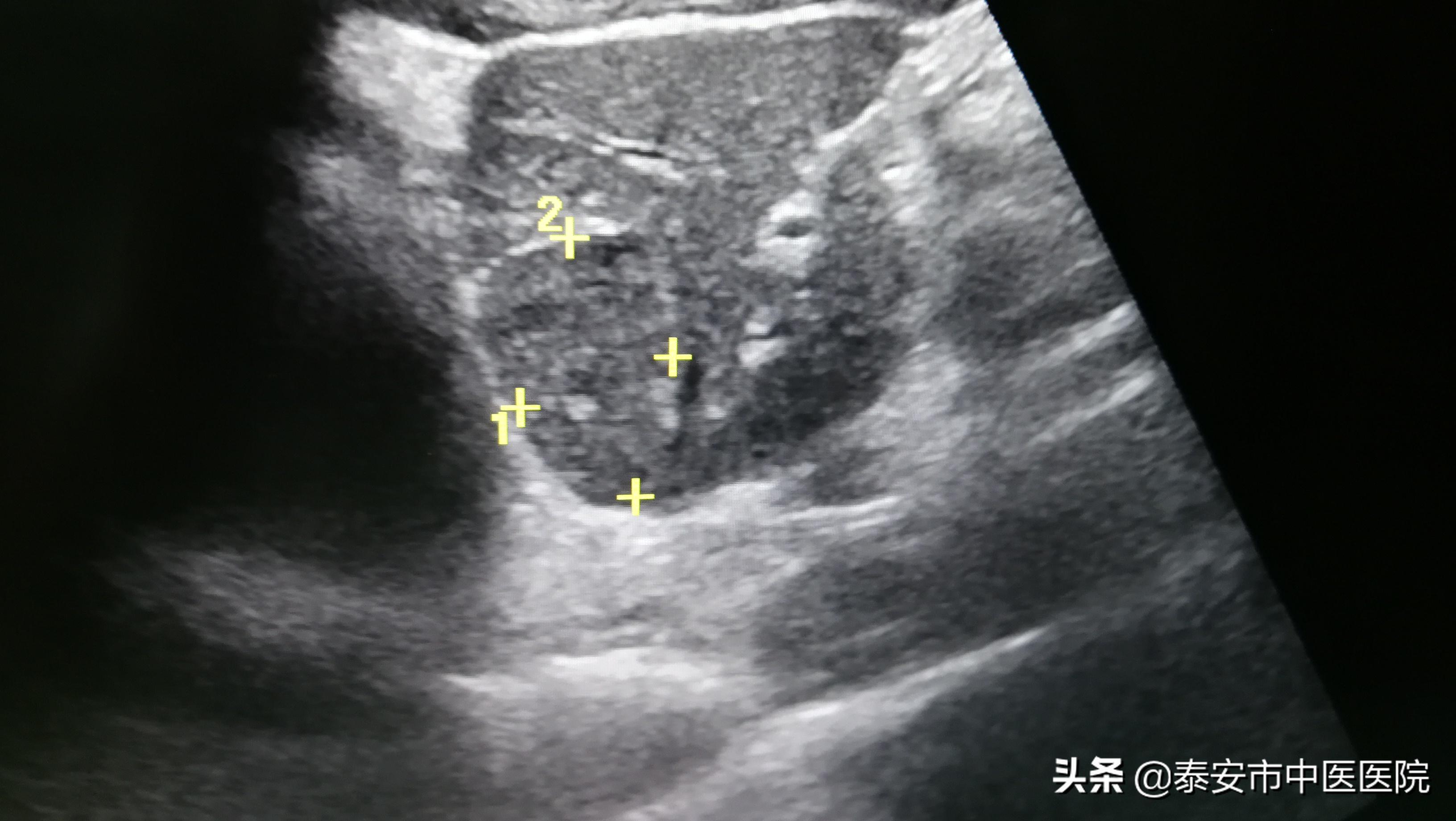 肝血管瘤射频消融术广东省中医院,射频消融治疗肝血管瘤需要住院吗