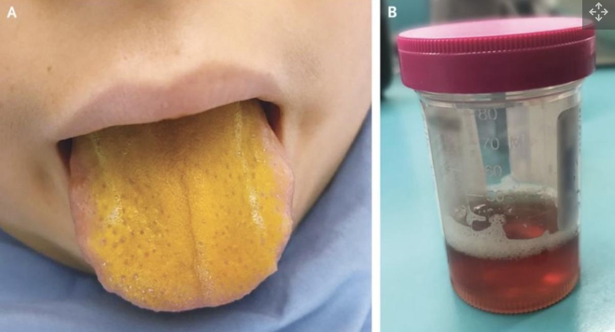 舌头突然之间变黄了怎么回事,舌头发黄警惕三种病