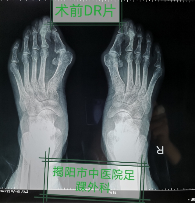 关注足部的健康,关注足部健康