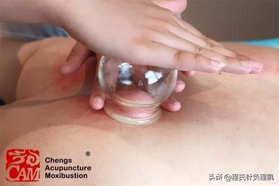 腰疼寒气重外敷处方,受寒腰痛可以拔火罐