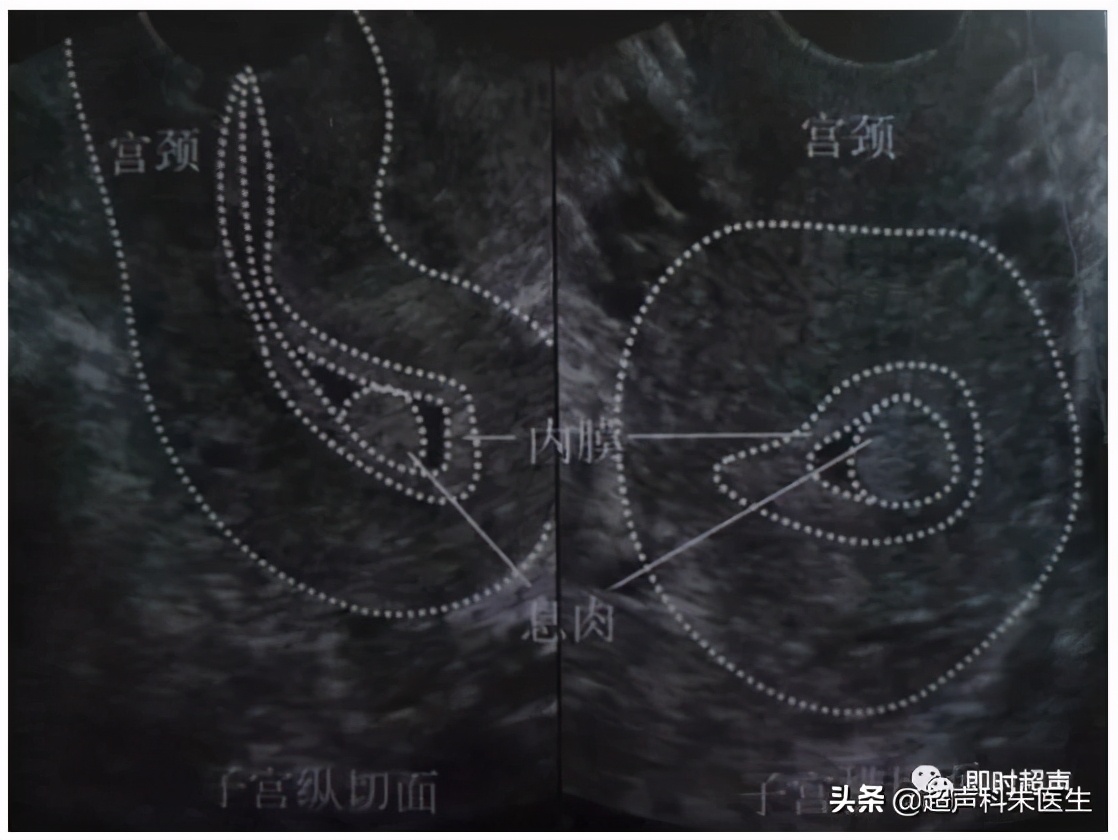妇科常见疾病的超声诊断视频,超声常见疾病