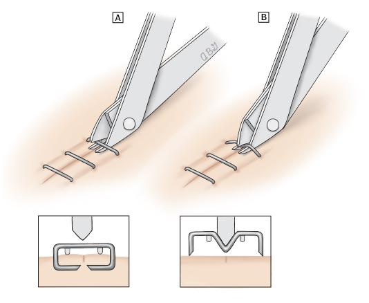 外伤缝合人工好还是订书机缝合好,骨科手术为什么用缝合钉