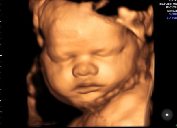 澶╂墠鑳庡効瀹岀粨,澶╂墠鑳庡効