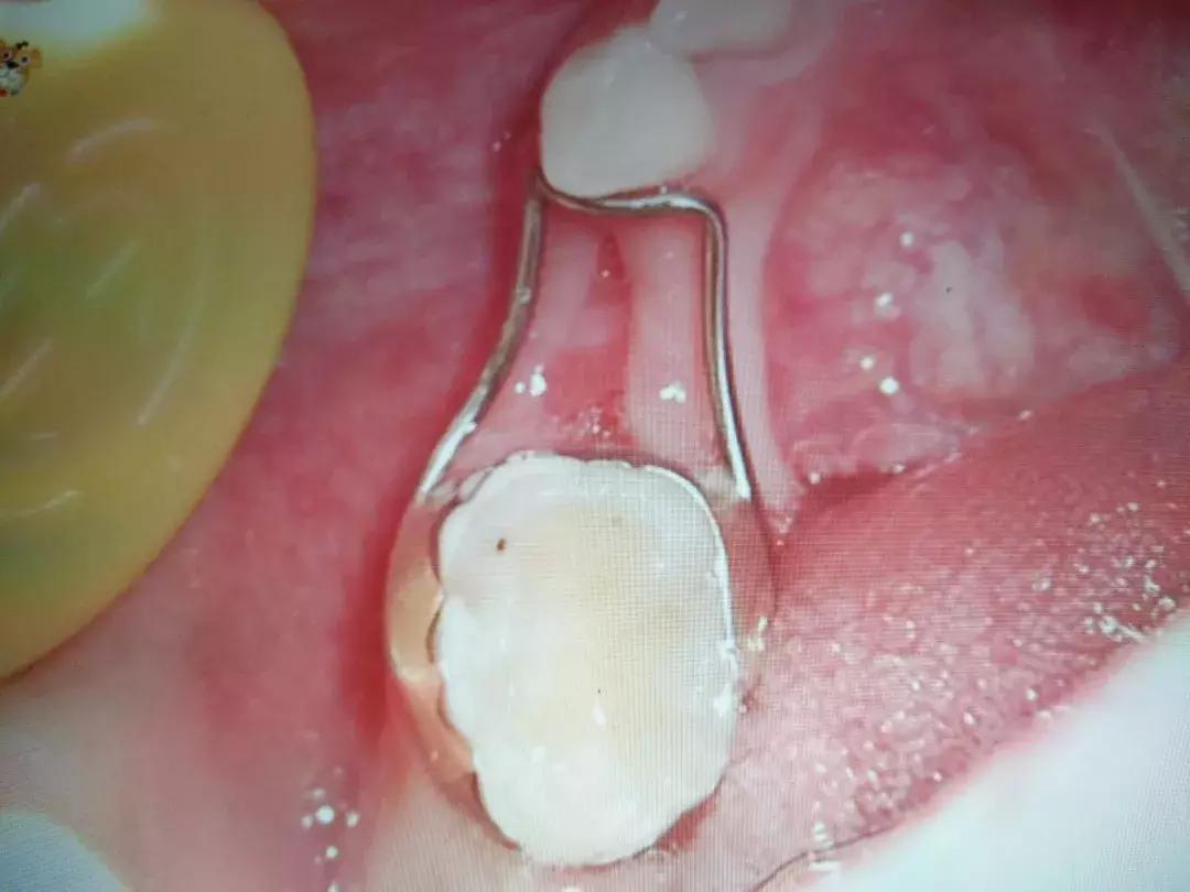 换牙期乳牙滞留恒牙歪了还能长,孩子换牙期牙齿稀疏怎么办