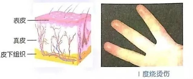 现场处理轻度烧烫伤最佳急救措施,对于烧烫伤的伤病员现场处理方法