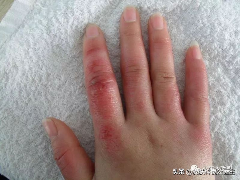 冻疮后期接触水干燥发痒怎么治,冻伤痒痛