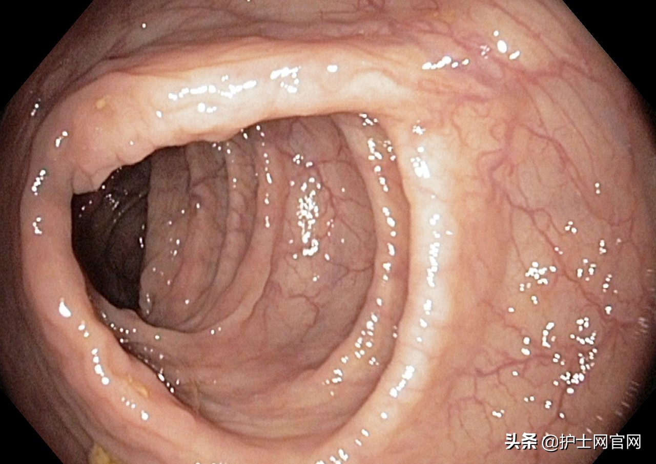 做肠镜感觉很尴尬,做肠镜说肠道脏是为什么