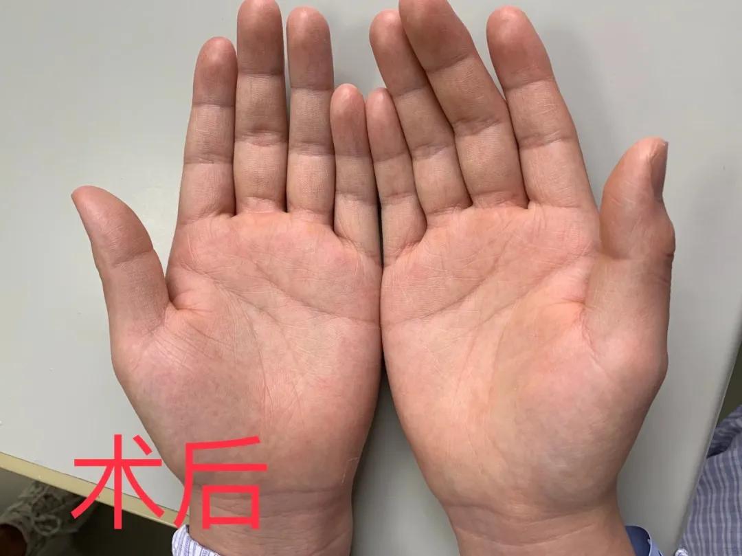 “滴水”的手汗症可以这样治