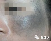 用祛斑霜为啥斑还越来越多,不要浪费护肤品
