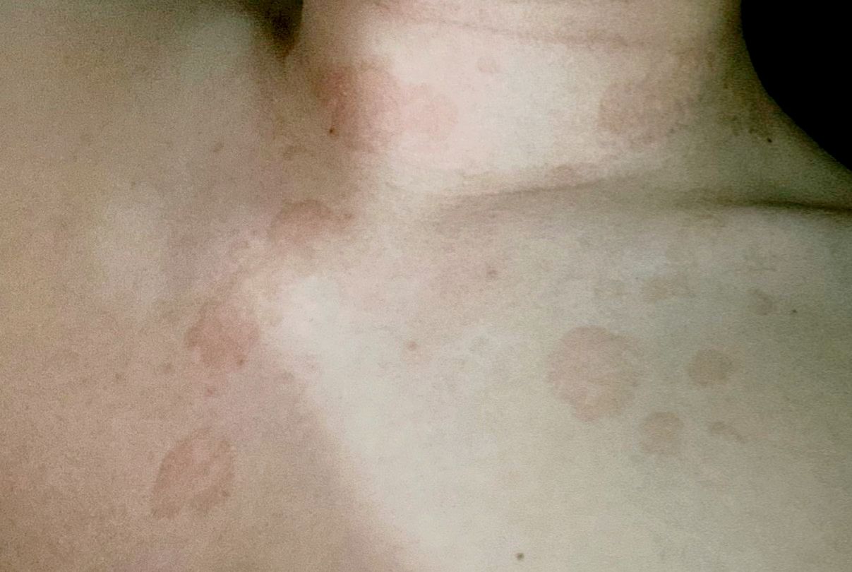 小儿如何才能根治汗斑足癣,汗斑怎么去除才能彻底根治