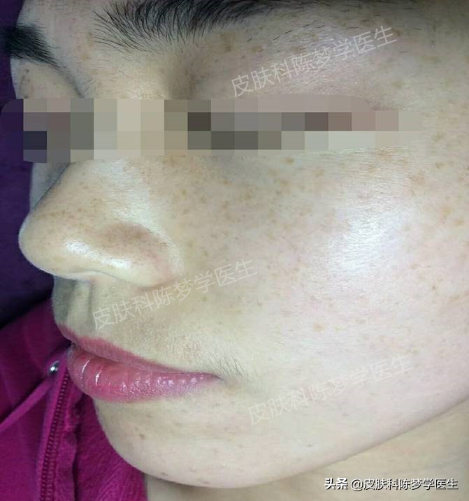 褐青色痣斑吃什么中药好,如何治疗脸上褐青色痣样斑