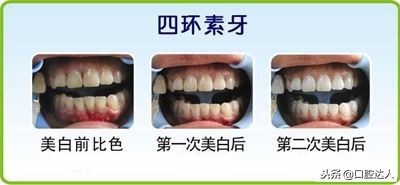 牙齿刷不白一直很黄什么原因,小孩的牙齿不白是啥原因