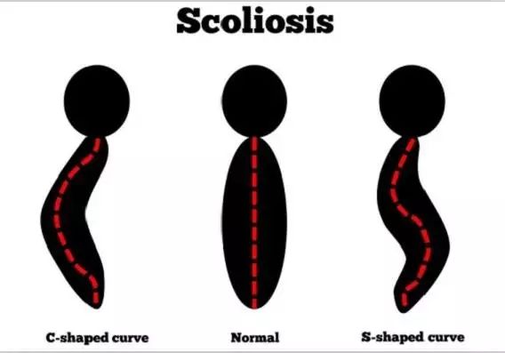 儿童坐姿不好引起的脊柱侧弯,书桌高低对孩子的影响