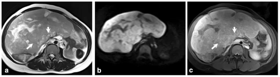 卵巢实性为主肿瘤，这13种你都想到了吗？