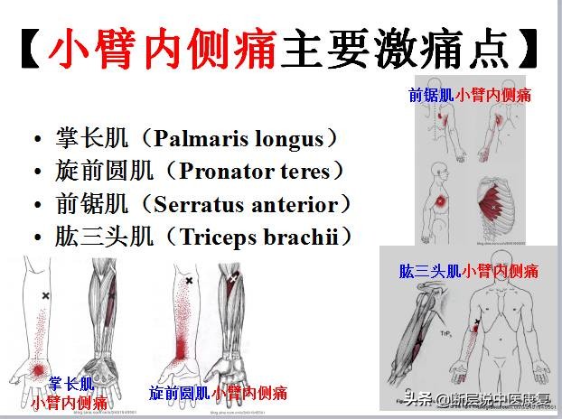 激痛点挂图,激痛点疗法笔记