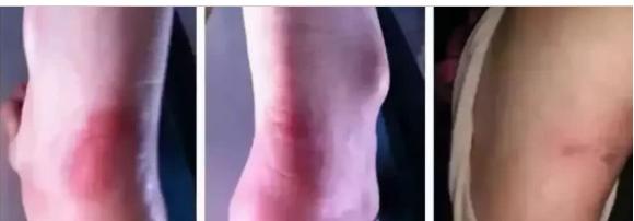 美美的高跟鞋穿起来脚经常磨破皮，有何妙招挽救破皮现象？