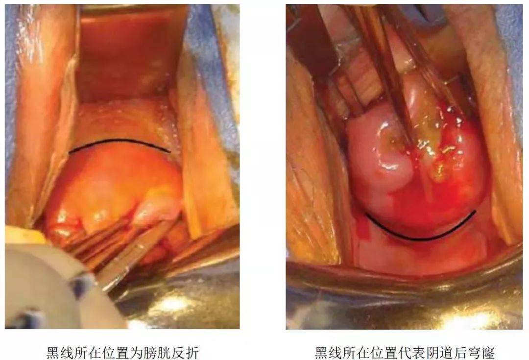 孕期宫颈环扎是怎么做,宫颈机能不全做环扎成功率有多高