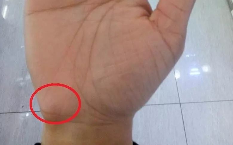 手诊10种常见病从手上就能看出来,手形看健康