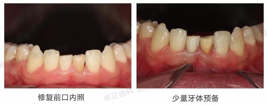 牙齿楔状缺损修复视频,牙齿缺损了可以选择哪些修复方式