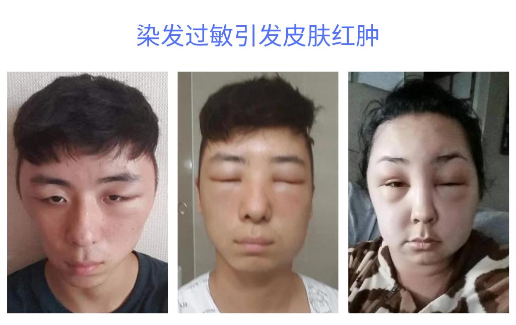 染发头皮痛是染发剂差吗,染发剂沾头皮是染发剂不好吗