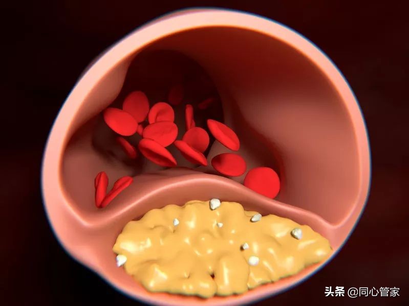 补钙血管钙化,补钙补多了会得动脉硬化么